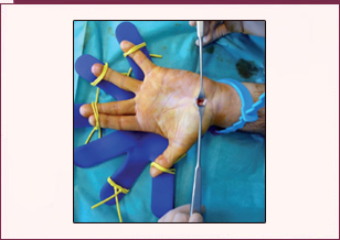 Universal tendon spacer