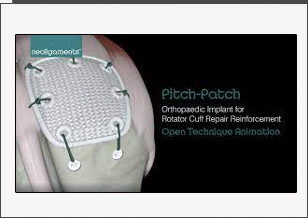 Pitch-Patch