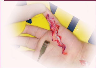 Universal tendon spacer